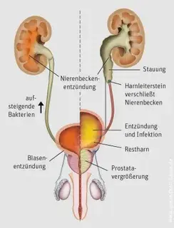 blasenentzündung mann symptome (1)